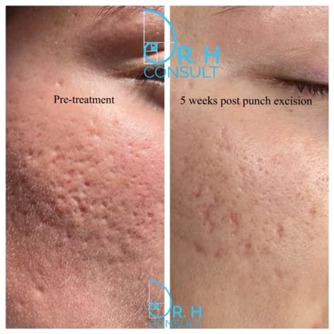 acne scar laser treatment and removal london dr h consult