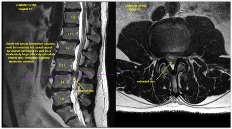 Image Result For Mri Image Of Spinal Ligament Lumbar My XXX Hot Girl