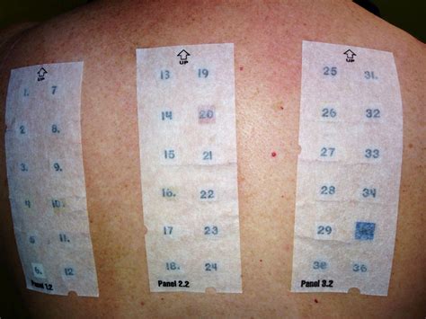 Patch Testing Allergists In Des Moines Iowa