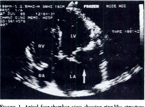 Figure 1 From Perforated Aneurysm Of The Anterior Mitral Valve A