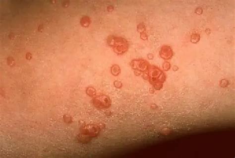 Molluscum Contagiosum Symptoms Causes Treatment And Life Cycle