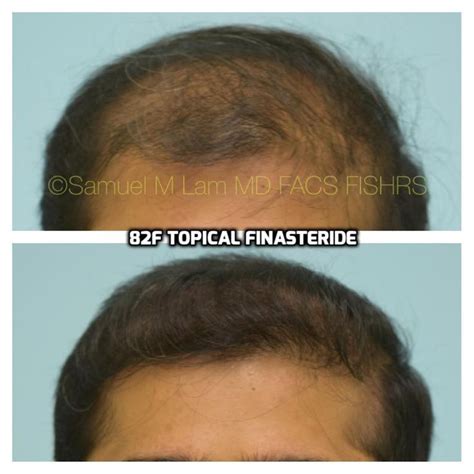 This 26 Year Old Indian Man Is Shown Before And Five Months After Starting Topical Finasteride