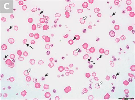 Blood Smear Platelet Evaluation And Interpretation Clinicians Brief