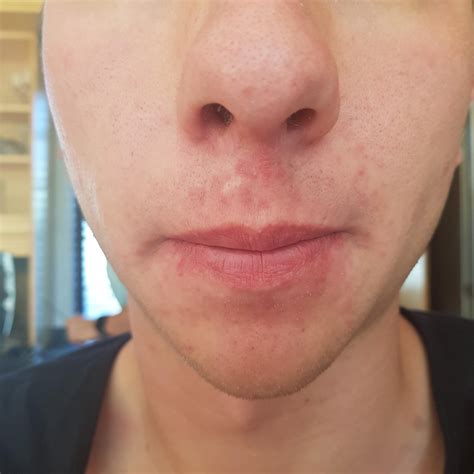 Skin Concern Irritation On My Upper Lip Due To New Relationship