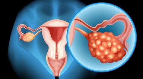 Ovarian Cancer Symptoms A Definitive Guide To Ovarian Health