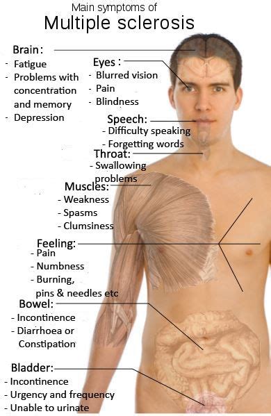 Demyelination causes symptoms of multiple sclerosis. Pin on Spoonie