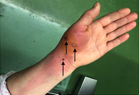 Cureus Rapidly Progressive Infection Of Hand After A Cat Bite