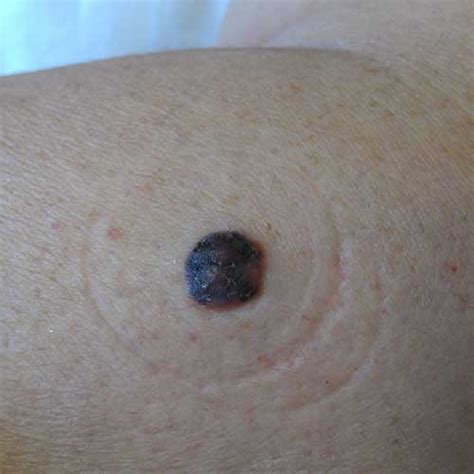 Pictures Of Facial Melanoma