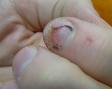A patient attempts to hide a fungal toenail infection under acrylic nails. Acrylic Nail Lifting | HOME DECORATION LIVE