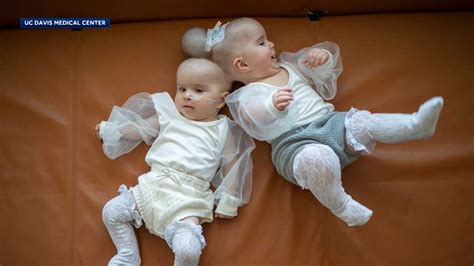 Conjoined Twins Separated At The Head