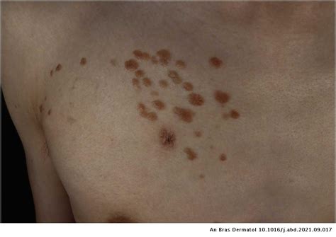Unilateral Linear Syringoma On The Right Chest And Arm Anais