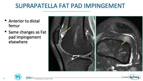 Knee Mri Fat Pad Impingement Where To Look And What To Look For Radedasia