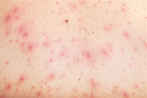 Chicken Pox Symptoms In Adults Pictures Mahilanya