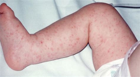 Meningitis Rash Pictures Symptoms Causes Treatment Prevention