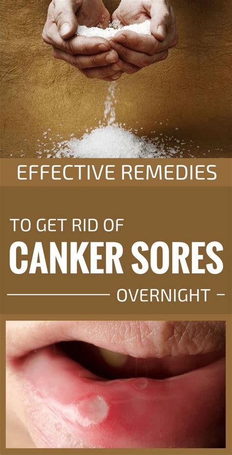 Effective Remedies To Get Rid Of Canker Sores Overnight Healthy