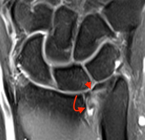 Displaced Triangular Fibrocartilage Cartilage Complex Tears Radsource