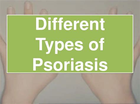 Ppt Different Types Of Psoriasis Powerpoint Presentation Free