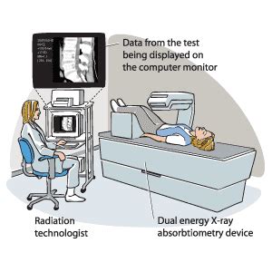 Bone density, or bone mineral density (bmd), is the amount of bone mineral in bone tissue. Bone mineral density test. Causes, symptoms, treatment ...