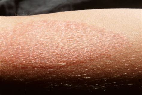 Dermatitis atópica la segunda enfermedad de la piel más diagnosticada en el mundo Diario La