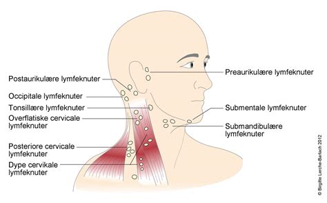 Lymphknotenkrebs als ursache für geschwollene lymphknoten. Hovne lymfeknuter hos barn, veiviser - NHI.no