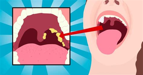 4 Signs You Have Tonsil Stones And How To Treat Them