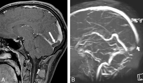 Cerebral Venous Thrombosis Diagnostic Accuracy Of Combined Dynamic