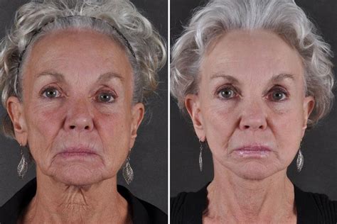 Exercises For Sagging Neck And Jowls Ph