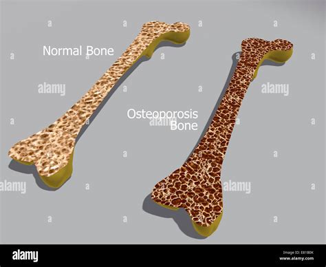 Comparison Of A Healthy Bone And A Bone With Osteoporosis Stock Photo