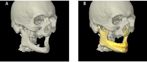 Even In Edentulous Patients With Severe Atrophy Of The Mandible A