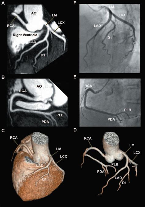 30t Whole Heart Coronary Magnetic Resonance Angiography Performed With