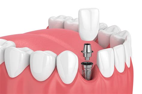 Mini Dental Implants Charleston Wv Mountain State Oral And Facial