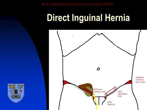 Inguinal Hernia Surgical Anatomy