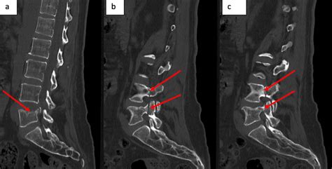 Cureus Bilateral Acute Osteoporotic Lumbar Pedicle Fracture