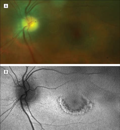Fundus Autofluorescence In Hydroxychloroquine Toxicity Clinical