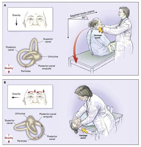 Management Of Benign Paroxysmal Positional Vertigo With The Canalith Repositioning Maneuver In