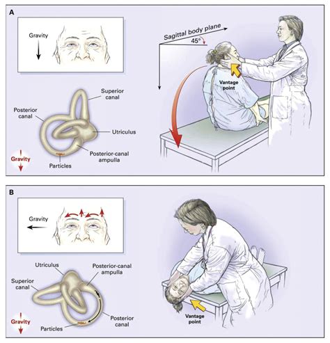 Epley Maneuver Illustration