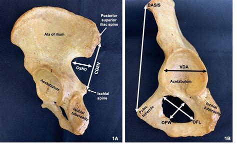 Left Hip Bone Showing Some Relevant Anatomical Structure As Well As The