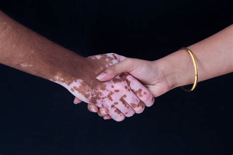 Le Vitiligo Causes Et Traitement Ilajak Médical