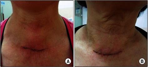Skin Changes On The Cervical Area After Thyroid Surgery Physicians