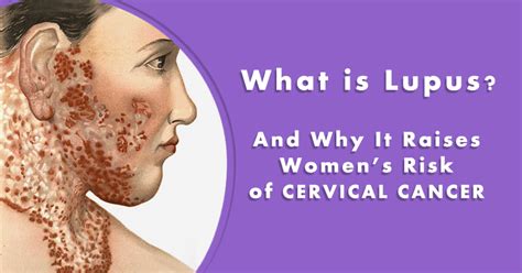 What Is Lupus And Why It Raises Womens Risk Of Cervical Cancer