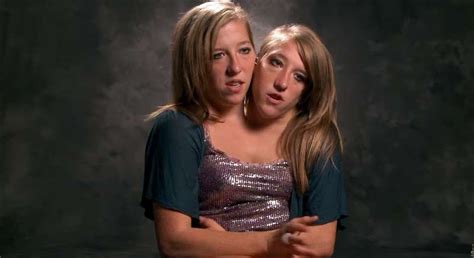 These Conjoined Twins Share Exciting News 22 Years After Their Birth