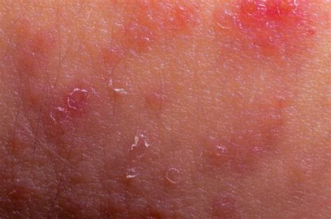 Skin Diseases List Of Common Conditions And Symptoms