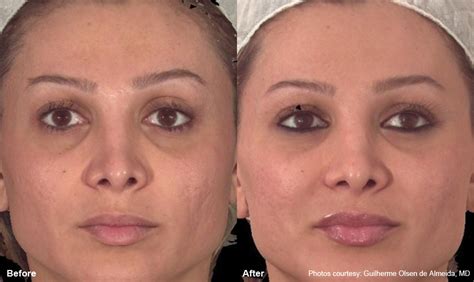 Skin Resurfacing Reduce Wrinkles Age Spots Loose Skin
