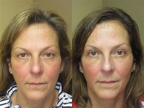 upper blepharoplasty before and after photos boston eyelids