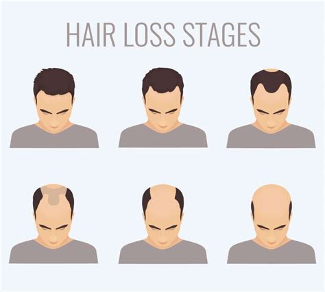 Mens Hair Loss And Solutions Hpi Hair