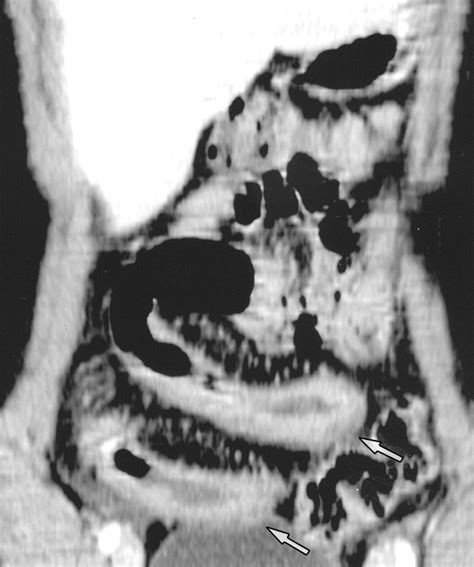Comparison Of Multidetector Ct And Barium Studies Of The Small Bowel