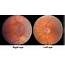 Optic Nerve Sheath Meningioma – Case Based Neuro Ophthalmology