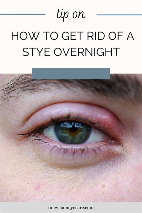 How To Get Rid Of A Stye Quickly Overnight And Other Important