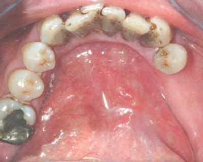 N20 Odontoiatria Cancro orale