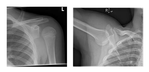 Nothing Humerus About It An Approach To Shoulder Dislocations — Brown